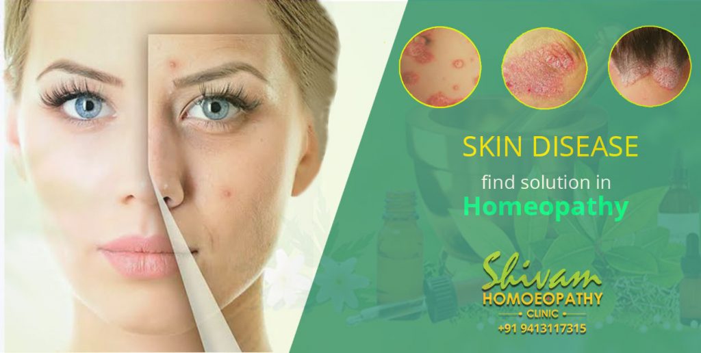 Skin Disease – Shivam Homeopathy Clinic